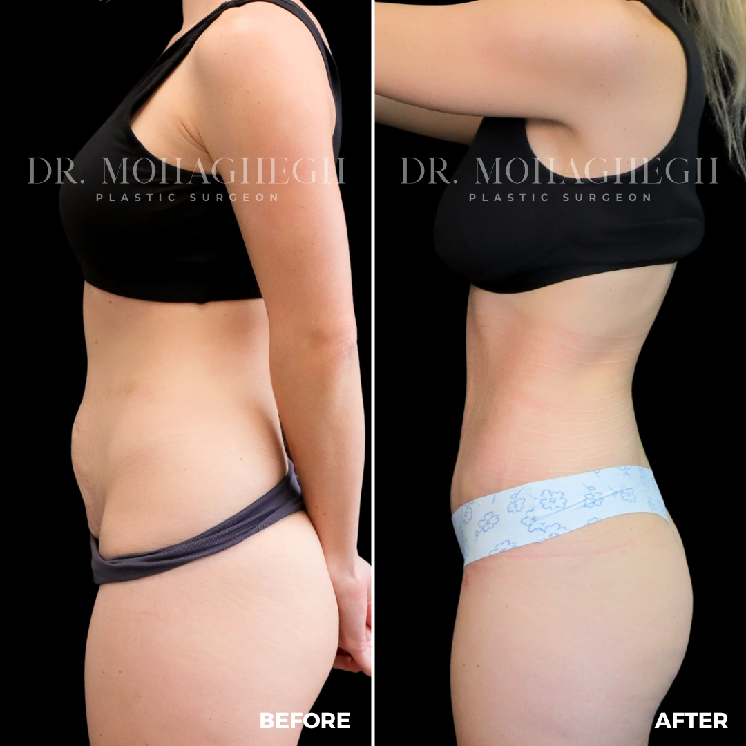 84_abdominoplasty