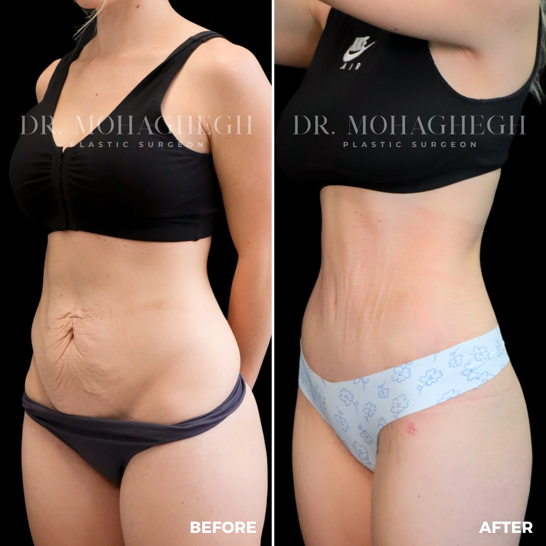 85_abdominoplasty