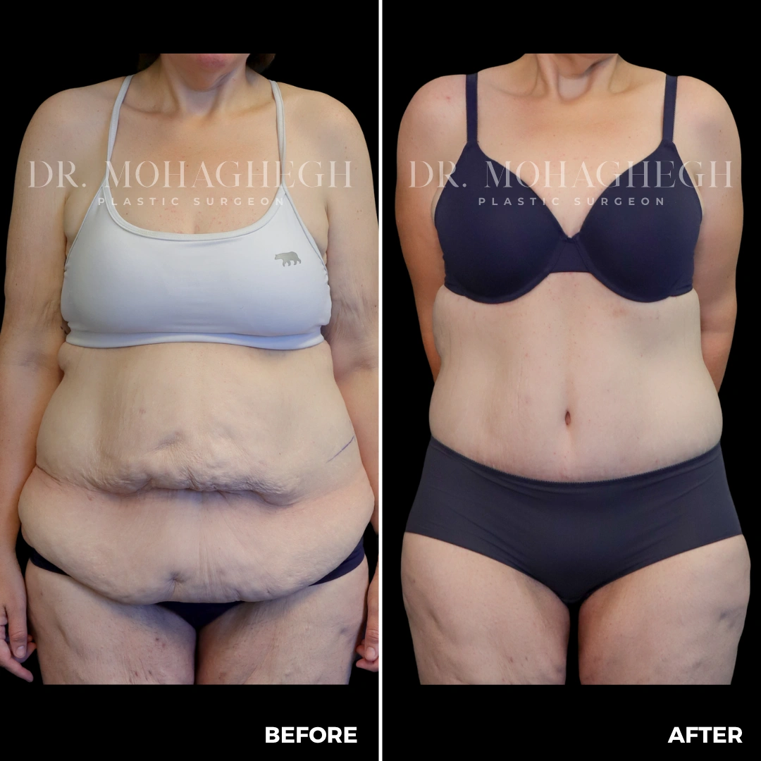 87_abdominoplasty