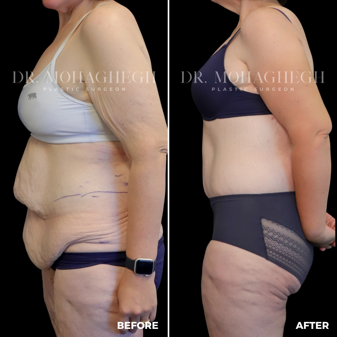 88_abdominoplasty
