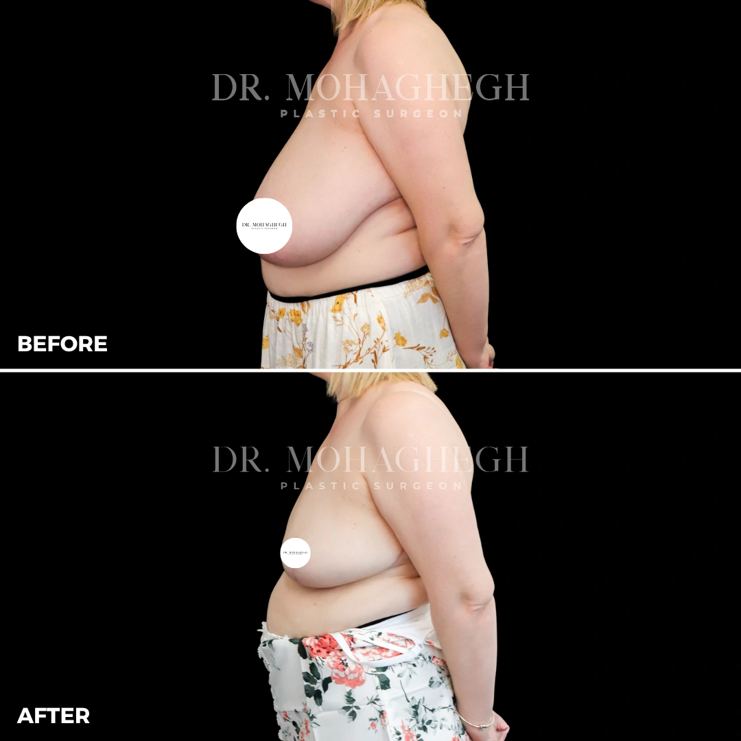 8_breast_reduction