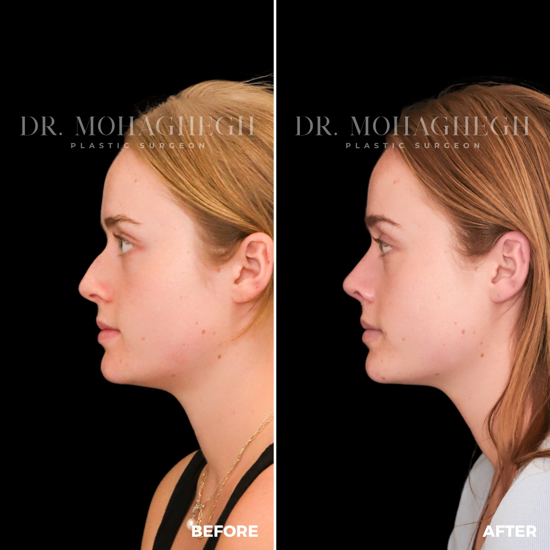 90_rhinoplasty