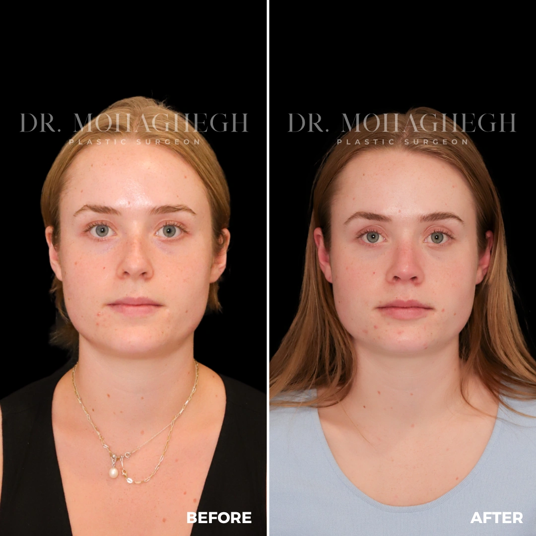 91_rhinoplasty