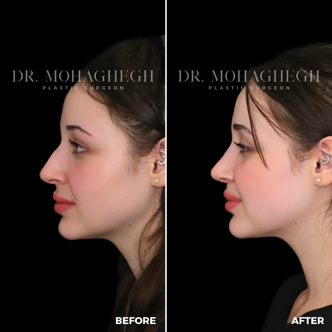 93_rhinoplasty