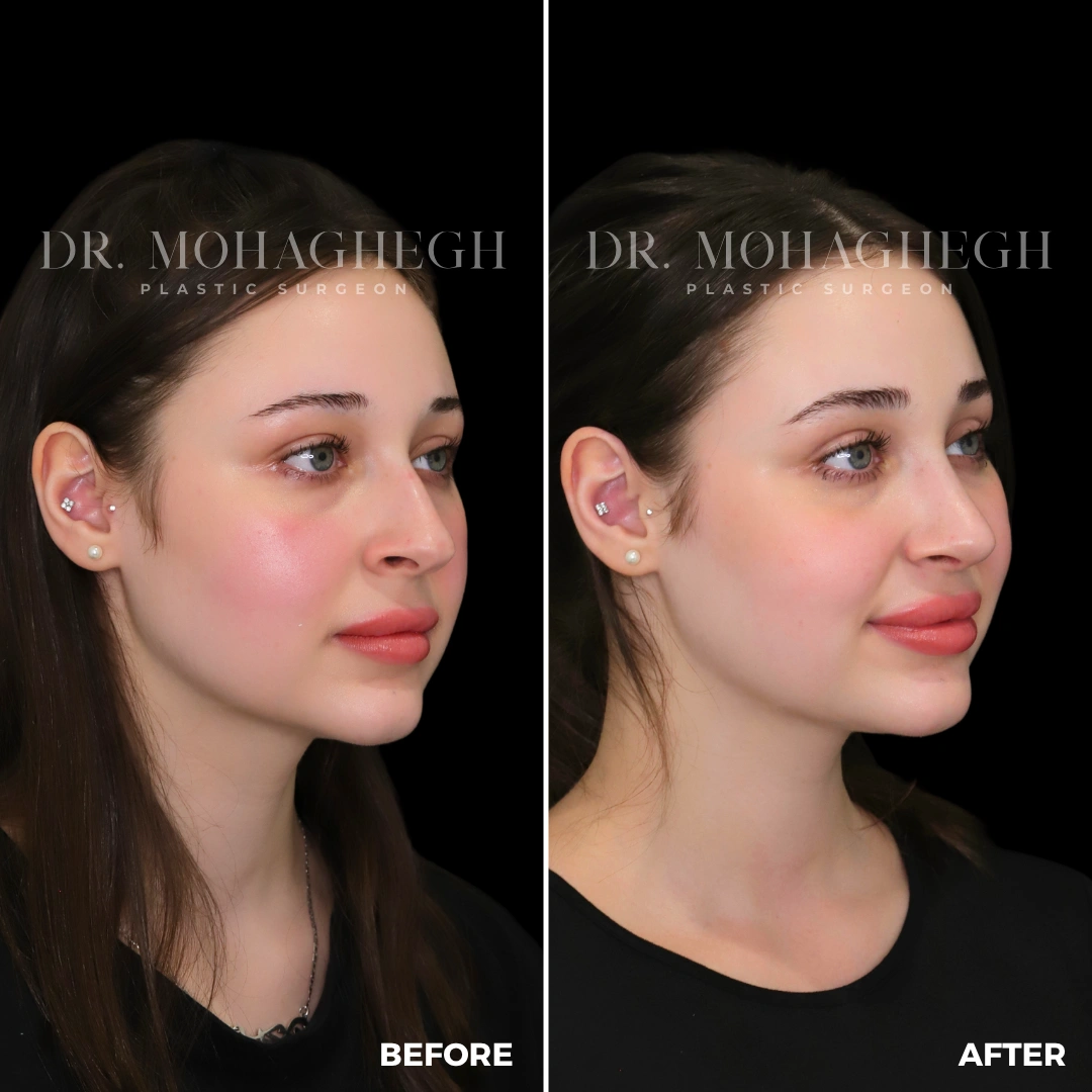 94_rhinoplasty