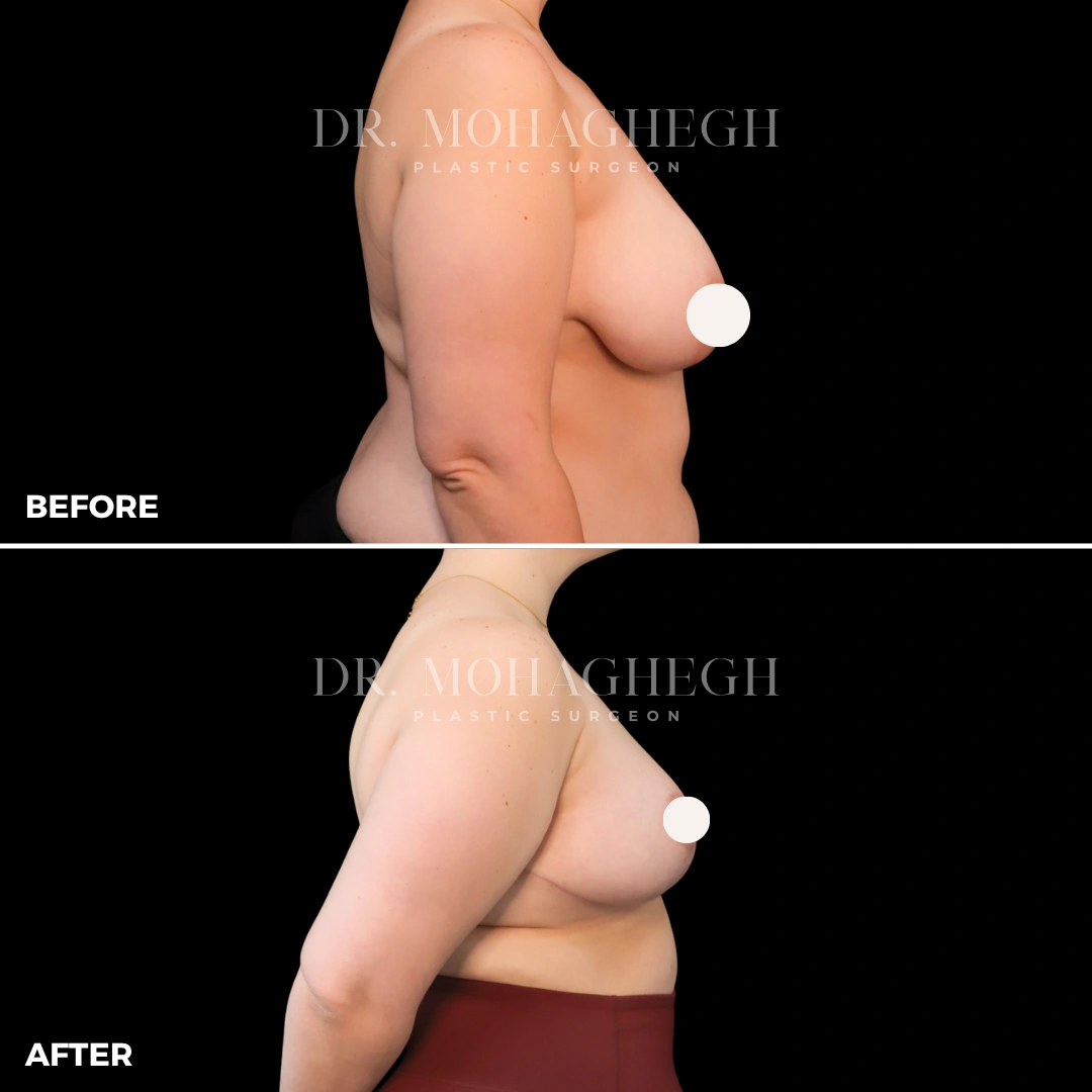 96_breast_reduction