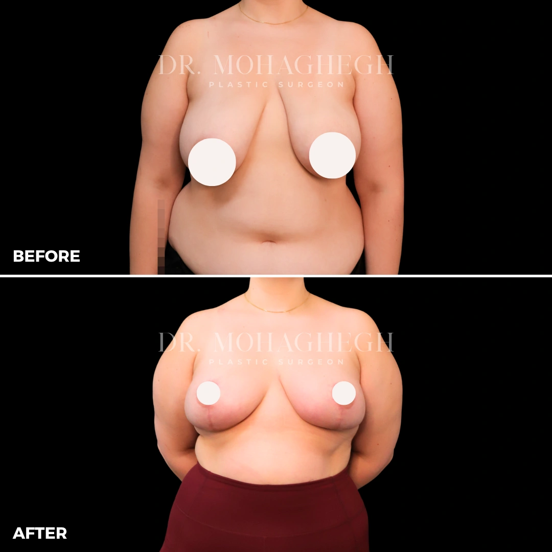 97_breast_reduction